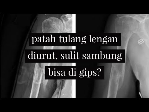 Video: Apa yang menyebabkan lengan kendali patah?