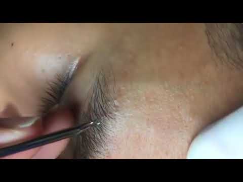 Acne, Blackheads, Pimples And Cystic Acne Removal On Face #