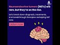 Neuroendocrine Tumors (NETs): silent, complex, &amp; often misdiagnosed