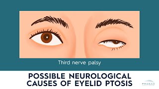 Neurological Causes of Ptosis: Myasthenia Gravis, Horner's Syndrome, and Third Nerve Palsy