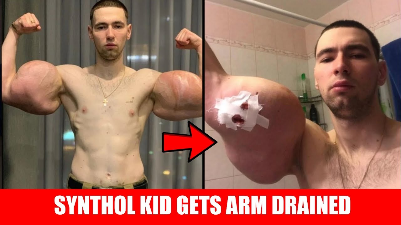 Synthol Kid Gets 3 Liters of Jelly Drained from Arm 