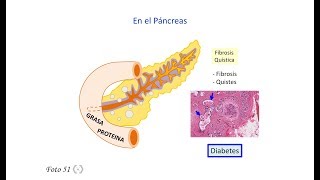 Fibrosis quística 2 - Patología