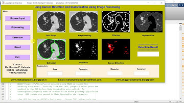 Lung Cancer Detection and Classification using Image Processing - Matlab Code