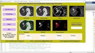 Lung Cancer Detection and Classification using Image Processing - Matlab Code