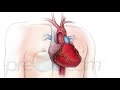 Diagnostic Cardiac Catheterization - PreOp® Patient Engagement and Patient Education