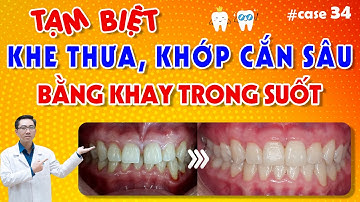 Tạm Biệt Khe Thưa, Khớp Cắn Sâu Bằng Khay Niềng Răng Trong Suốt Vinalign | Nam Bùi Vinalign