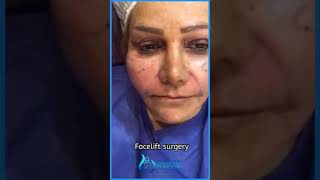 Facelift surgery in Iran