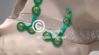 Corrective Jaw Surgery Orthognathic - Animation