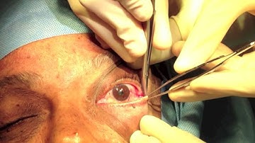 Canthotomy and Cantholysis - Chris Thiagarajah MD - Denver, Colorado