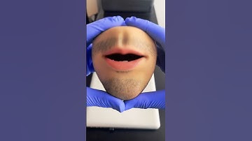 Will Mr Kiwi return? #mrkiwi #mrskiwi #fruitsurgery #foodsurgery