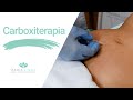 Disminuye FLACIDEZ, ESTRÍAS y CELULITIS con Carboxiterapia | María Linda