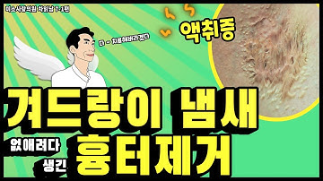 겨드랑이냄새제거 수술을 했는데 흉터가 생겼다? 흉터 치료의 종착점 핀홀셀 요법