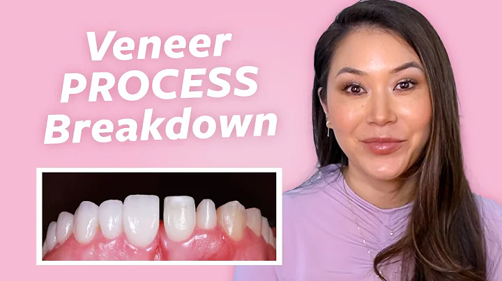 Veneers Process Step-By-Step | Joyce the Dentist