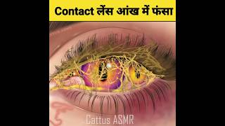 Contact Lens कस नकल गयHow To Remove Contact Lens 