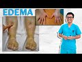 ¿Qué es el Edema? – Fácil