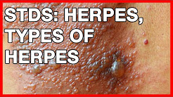 STDs: Herpes, Types of Herpes, Symptoms and Treatment