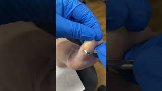 Experience The Relief Of Dry Big Toe Callus Removal! Watch Now! #Podiatrymagic #Footcarefirst
