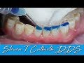 Bonding Worn Anterior Teeth - Dental Minute with Dr  Steven T. Cutbirth, DDS