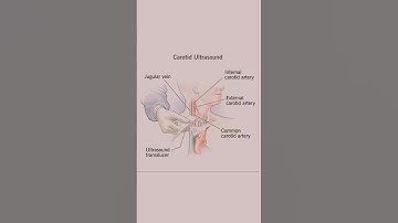 Carotid Ultrasound Explained | Common vs Internal vs External Carotid Artery #viralvideo