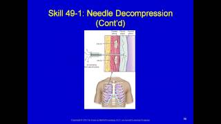 Thoracic (chest) trauma for the EMS provider