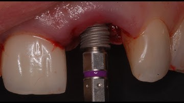 Socket shield technique & immediate load tooth #9 DR OMID TERMECHI