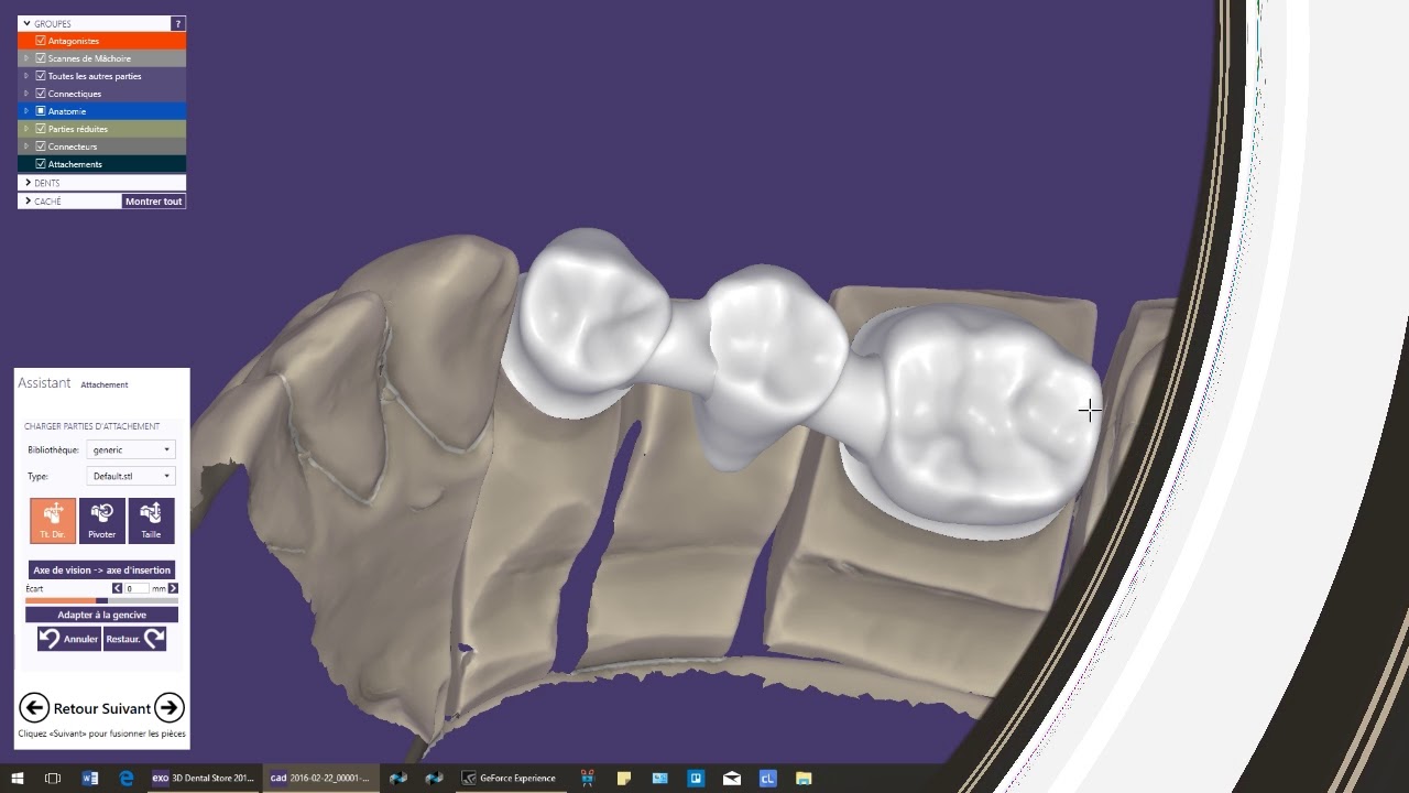 Exocad: Parallèliser ses attachements