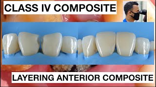Step by Step Class IV  Composite Restoration Free Hand Technique | General Dentist Griya RR