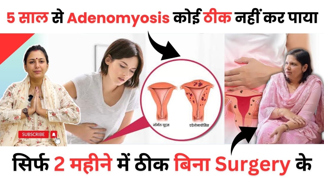 adenomyosis-symptoms-treatments-hindi-adenomyosis-treatment-without