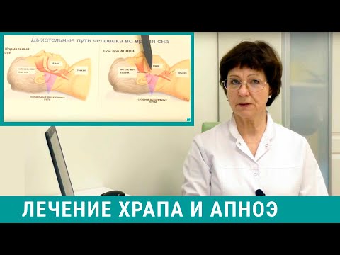 Как избавиться от храпа? Лечение храпа и апноэ