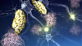 Alzheimers disease screenshot 4