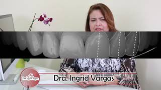 Ingrid Vargas - Diferencias Entre Carillas De Porcela Y Resina Compuesta?