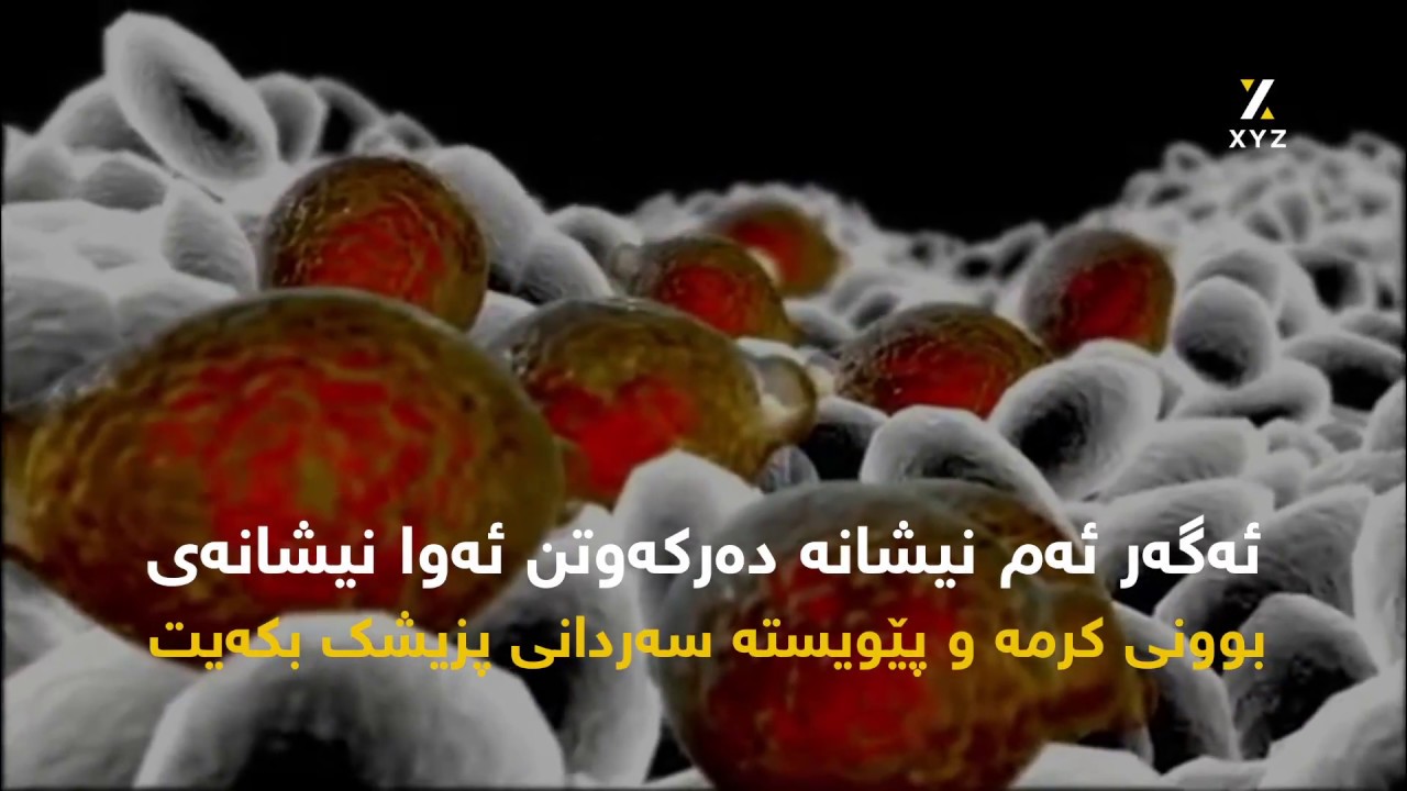 چۆن دەزانیت لەشت کرمی هەیە؟