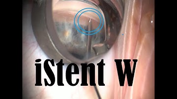 How to: iStent Inject W --- when the stent slips out