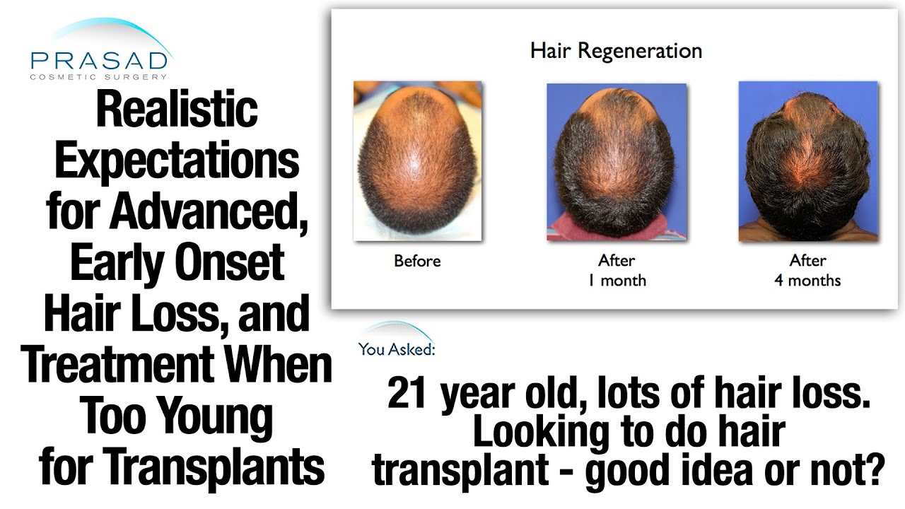 Male Pattern Baldness Stages Custom Design Male Pattern Baldness Stages Custom Design
