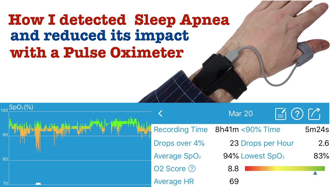 Detecting Mild Sleep Apnea with a pulse oximeter - Something weird was going on with my sleep - it turned out to be sleep apnea.
