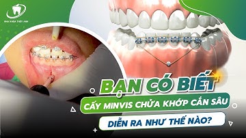 Bạn Có Biết "Cấy Vít" Đánh Lún Hàm Dưới Để Chữa Khớp Cắn Sâu diễn ra như thế nào?