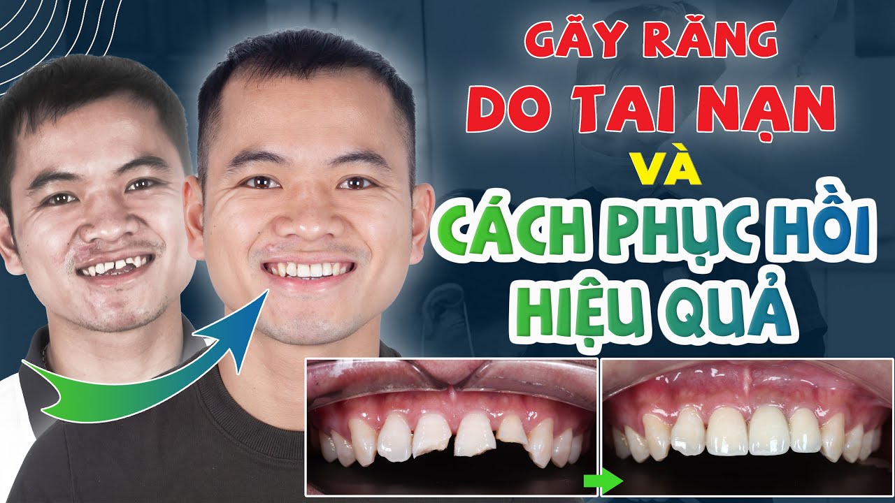 PHỤC HỒI HOÀN CHỈNH LẠI RĂNG CỬA GÃY RĂNG DO TAI NẠN - YouTube