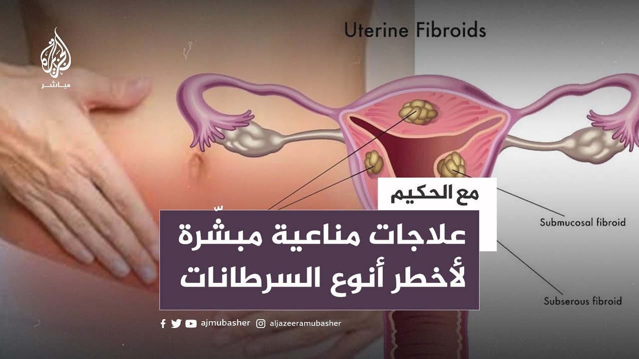 علاجات مناعية مبشّرة، لأخطر أنوع السرطانات النسائية وأكثرها انتشارًا؟