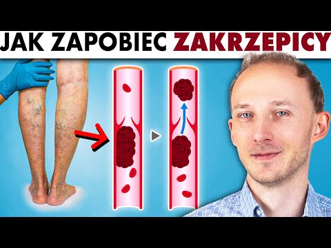 Wideo: Jak zdiagnozować zakrzep krwi (ze zdjęciami)