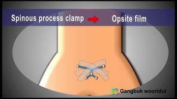 pedicle screw fixation with 3D O-arm and navigation