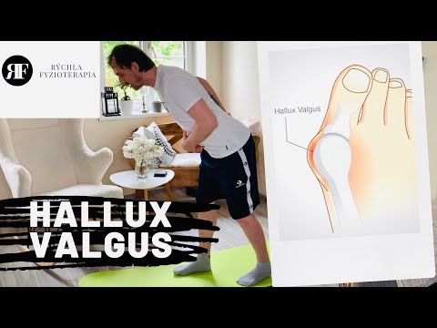 Video: Liečba Hallux Valgus