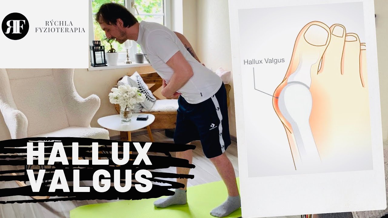 Hallux Valgus - AKO NA TO !  Rýchla fyzioterapia