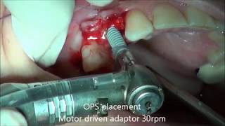 Nik Dental Implant System - Soft bone and OPS placement screenshot 2