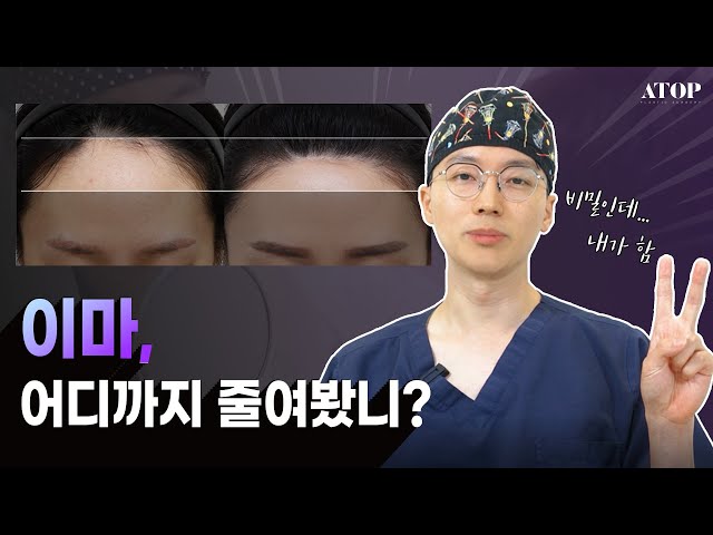 [Dr.권준성] 이마축소, 성공하는 케이스는 따로있다?👍👍