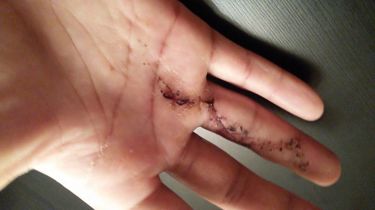 Контрактура дюпюитрена процесс заживления после операции 2 - YouTube