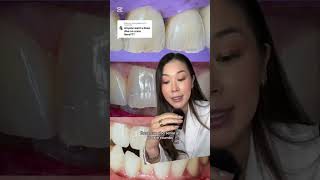 Ready for a deep dive on craze lines? #teeth #crackedteeth #teethlines #dentist