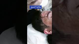 ليزر ازاله الحروق وتشوهات الجلديه مجاني على حساب القناه اي شخص عده  حرق جلسات مجاني هذا من فضل الله