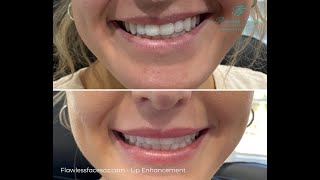 Flawless Faces AZ - Lip Enhancement
