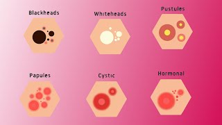 6 types of acne explained and their treatment