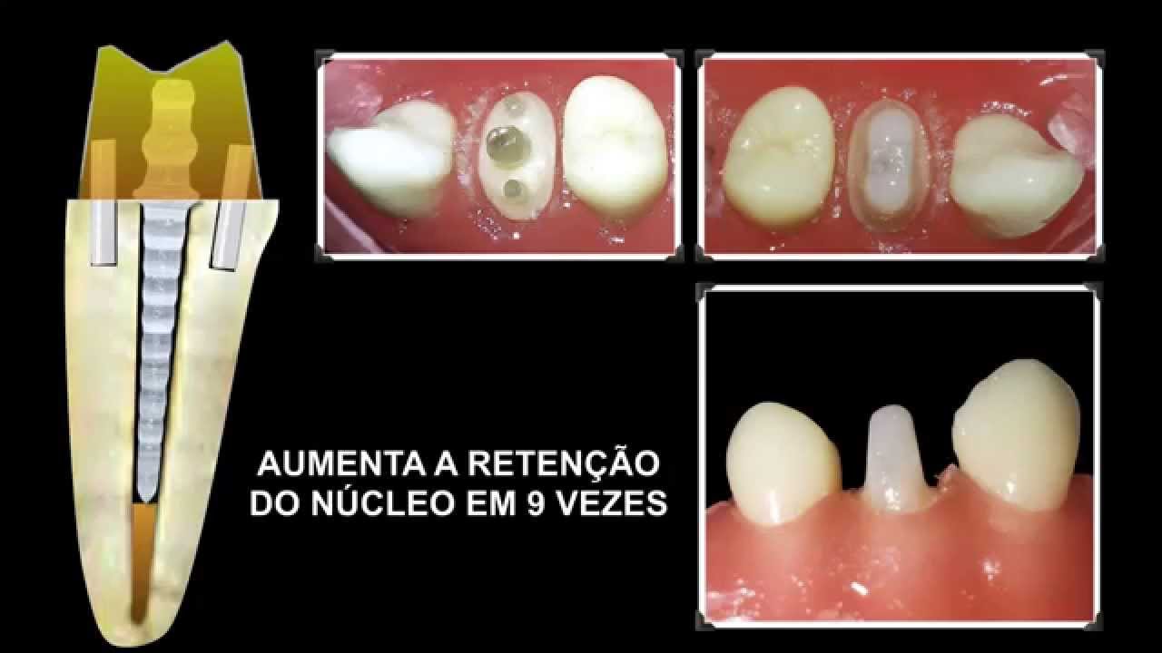 Coroa Provisória Com Pino - RETOEDU